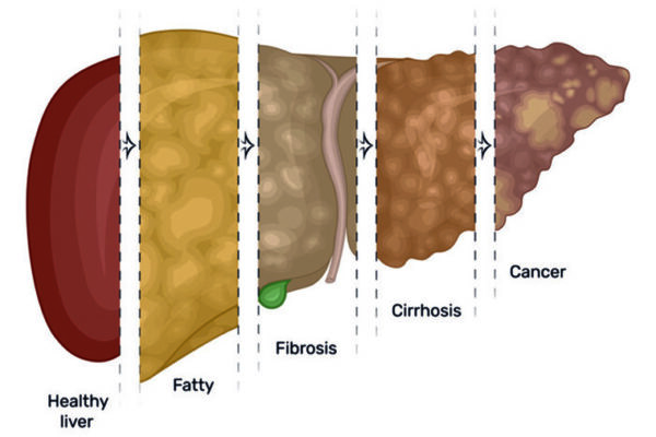 Study reveals links between fatty liver disease, liver cancer