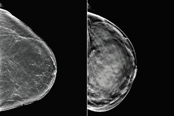 Algorithm analyzes mammograms, signals need for more breast cancer screening