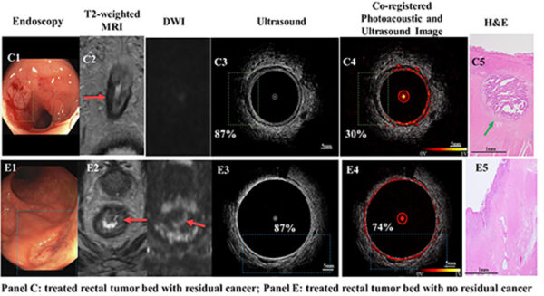 (From left) Ultrasound images, photoacoustic microscopy (PAM)/US images, and representative hematoxylin–eosin (H&E) stain of the tumor bed. Panel C: treated tumor bed with residual cancer; Panel E, treated tumor bed with no residual cancer. (Courtesy: Zhu lab)