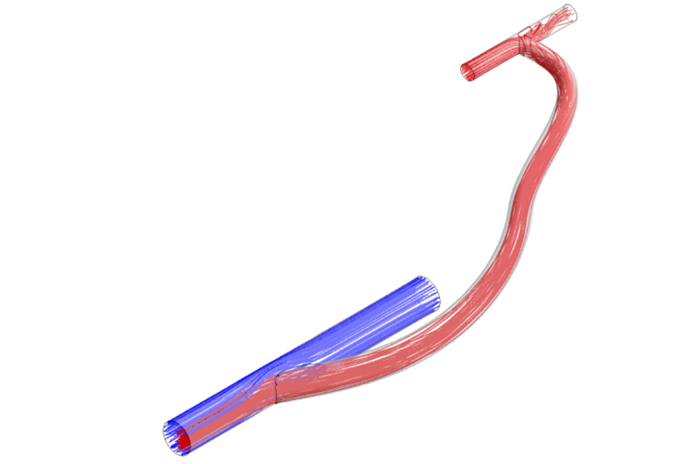 Illustration of an arteriovenous graft