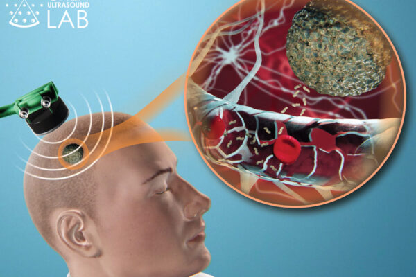 Noninvasive brain biopsy shows improved sensitivity