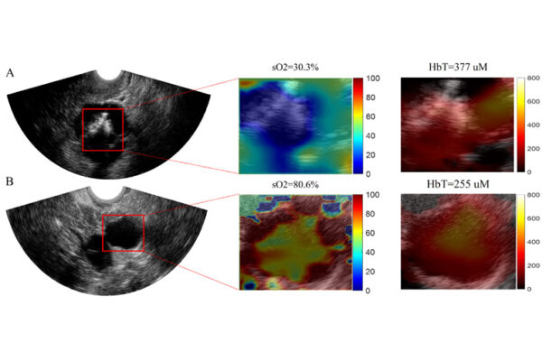 Machine learning model builds on imaging methods to better detect ovarian lesions