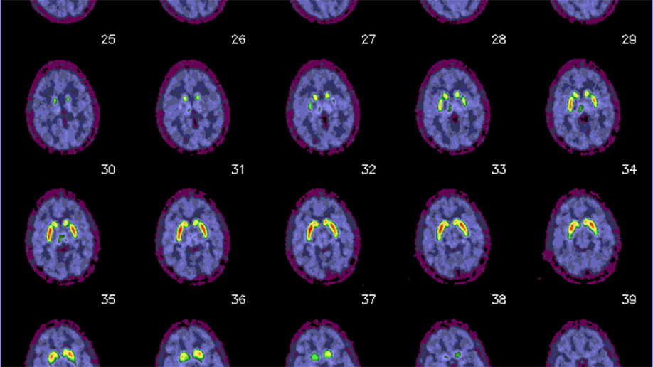 Red, yellow and green spots on a series of digital “slices” of a living 41-year-old woman’s brain reveal that the PET radiotracer [18F]-VAT has found its target deep in the center of the brain. The tracer was developed by researchers at MIR to detect early signs of dementia. This PET scan is normal, indicating a healthy brain. The colored areas would be smaller in the brain of a patient with dementia. (Credit: Zhude Tu, PhD, and Joel Perlmutter, PhD)