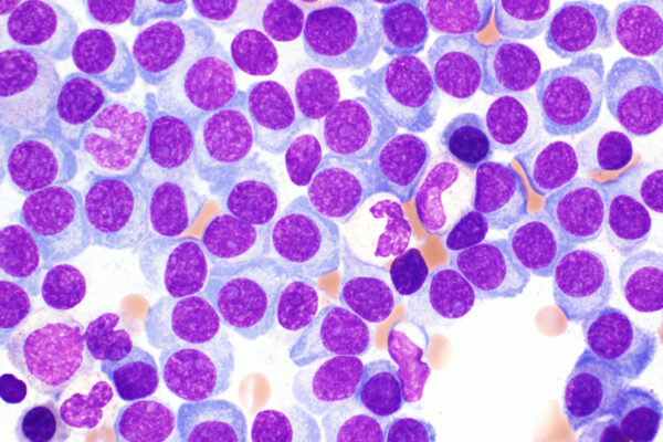 Investigational drug may improve stem cell transplantation for multiple myeloma patients