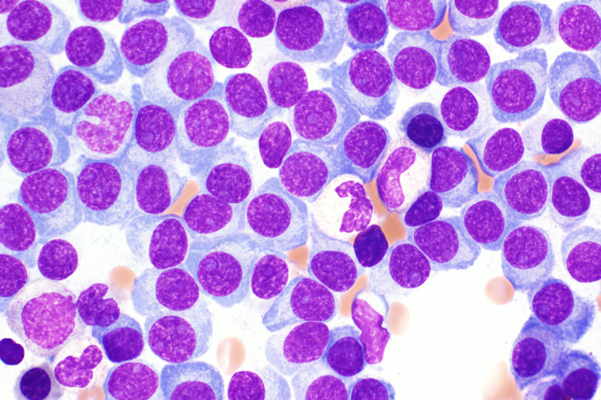 Investigational drug may benefit myeloma patients