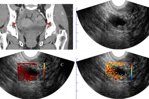 Photoacoustic imaging improves diagnostic accuracy of cancerous ovarian lesions