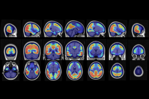 Tau protein deposition patterns predict Alzheimer’s severity 